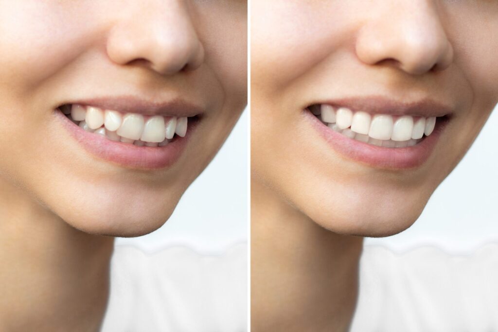 Smile before and after teeth straightening for mild crowding – Invisalign for minor cases